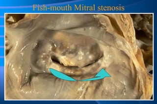 Fish-mouth Mitral stenosis 