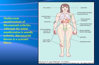 Multisystem manifestations of Rheumatoid arthritis. Although the initial manifestation is usually arthritis, Rheumatoid disease is a systemic illness. 
