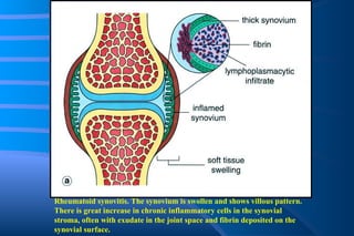 Rheumatoid synovitis. The synovium is swollen and shows villous pattern. There is great increase in chronic inflammatory cells in the synovial stroma, often with exudate in the joint space and fibrin deposited on the synovial surface. 