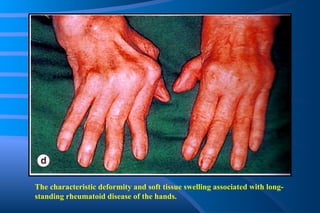 The characteristic deformity and soft tissue swelling associated with long-standing rheumatoid disease of the hands. 