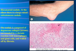 Rheumatoid nodule. At the elbow there is a large raised subcutaneous nodule. The nodule is composed of degenerate collagen (arrow) surrounded by a chronic reaction with macrophages and giant cells, and walled off by fibrosis. 