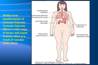 Multisystem manifestations of Systemic Sclerosis. Systemic Sclerosis affects a wide range of tissues and organ systems, often as a result of vascular obliteration. 