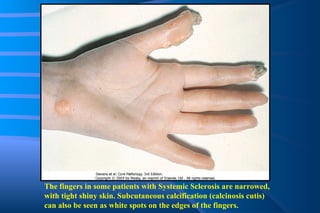 The fingers in some patients with Systemic Sclerosis are narrowed, with tight shiny skin. Subcutaneous calcification (calcinosis cutis) can also be seen as white spots on the edges of the fingers. 