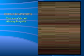 DERMATOMYOSITIS Take note of the rash affecting the eyelids. 