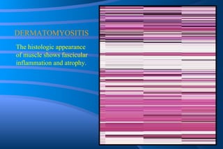 DERMATOMYOSITIS The histologic appearance of muscle shows fascicular inflammation and atrophy. 