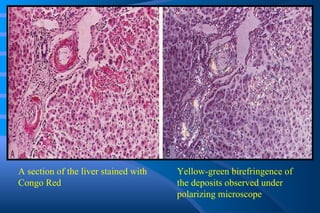 A section of the liver stained with Congo Red Yellow-green birefringence of the deposits observed under polarizing microscope 