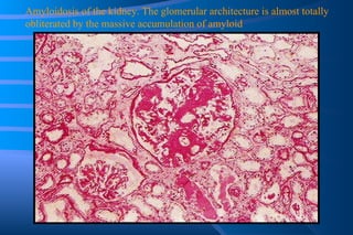 Amyloidosis of the kidney. The glomerular architecture is almost totally obliterated by the massive accumulation of amyloid 