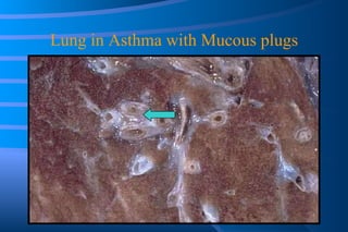 Lung in Asthma with Mucous plugs 
