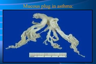 Mucous plug in asthma: 