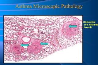 Asthma Microscopic Pathology Obstructed and inflamed bronchi 