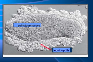 schistosoma ova eosinophils 