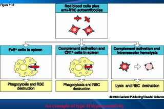 An example of type II hypersensitivity 