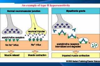 An example of type II hypersensitivity 