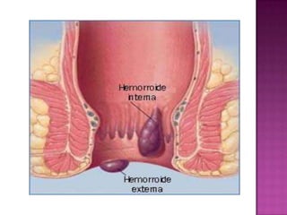FACTORES ASOCIADOS:ANTECEDENTES FAMILIARES    EL EMBARAZO ES LA CAUSA MÁS COMÚN DE HEMORROIDES EN LAS MUJERES JÓVENES.LA TROMBOSIS DE LA VENA PORTA Y LA CIRROSIS HEPÁTICA.EDAD AVANZADA