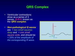 QRS Complex Ventricular contractions show as a series of 3 waves,  Q-R-S , known as the  QRS complex .  Non­pathological Q waves  are  < two small squares deep  and  < one small square wide , and should be  < 25% of the amplitude of the corresponding R wave.   
