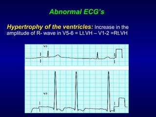 Abnormal ECG’s Hypertrophy of the ventricles:   Increase in the amplitude of R- wave in V5-6 = Lt.VH – V1-2 =Rt.VH 