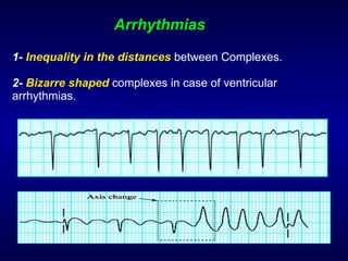 Arrhythmias 1-  Inequality in the distances   between Complexes. 2-  Bizarre shaped   complexes in case of ventricular arrhythmias. 