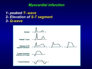 Myocardial infarction 1- peaked  T- wave 2- Elevation of  S-T segment 3-  Q-wave 