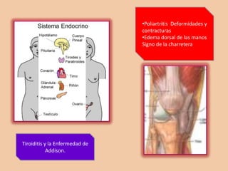 PRESENTACION CLINICA DE LA AMILOIDOSIS DISEMINADAAMILOIDOSIS PRIMARIASíndrome nefrótico de origen desconocidoInmunoglobulina monoclonal en orina o sueroSíndrome de Túnel carpianoMalabsorcion, o diarrea o estreñimiento de origen desconocidoNeuropatía periféricaMacroglosiaHepatomegaliaMiocardiopatía
