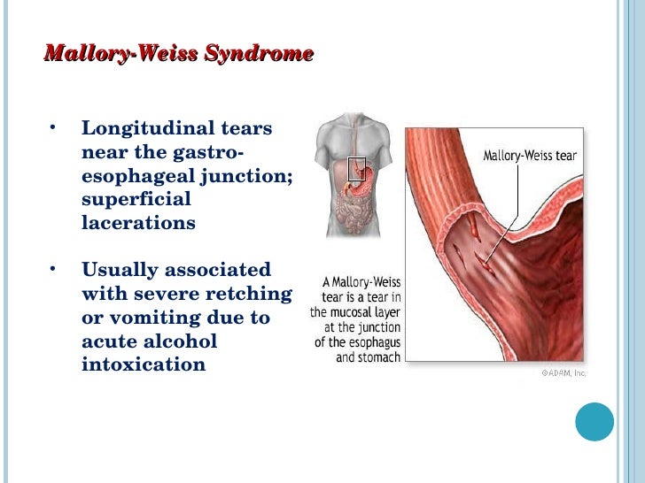 Синдром мэллори что это. Синдром маллори вейсса классификация. Синдром мэллори что это. Мэллори вейса патогенез. Синдром маллори вейсса.