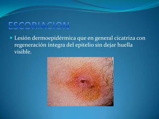 heridas | PPTX
