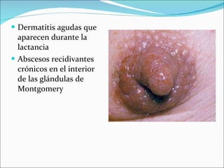 Dermatitis agudas que aparecen durante la lactancia Abscesos recidivantes crónicos en el interior de las glándulas de Montgomery 