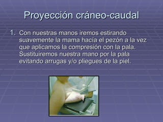 Proyección cráneo-caudal Con nuestras manos iremos estirando suavemente la mama hacía el pezón a la vez que aplicamos la compresión con la pala. Sustituiremos nuestra mano por la pala evitando arrugas y/o pliegues de la piel. 
