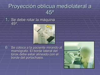 Proyección oblicua mediolateral a 45º Se debe rotar la máquina 45º. Se coloca a la paciente mirando al mamógrafo. El borde lateral del tórax debe estar alineado con el borde del portachasis. 