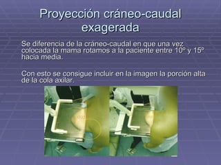 Proyección cráneo-caudal exagerada Se diferencia de la cráneo-caudal en que una vez colocada la mama rotamos a la paciente entre 10º y 15º hacia media. Con esto se consigue incluir en la imagen la porción alta de la cola axilar. 