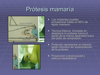 Prótesis mamaría Los implantes pueden enmascarar hasta un 85% de tejido mamario. Técnica Eklund. Consiste en desplazar la prótesis hacía el dorso de la mama dejándola fuera del plato de compresión. Pretende representar el máximo tejido mamario sin superposición de la prótesis. Proyección cráneocaudal y oblicua mediolateral. 