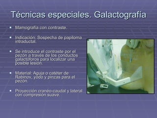 Técnicas especiales. Galactografía Mamografía con contraste. Indicación: Sospecha de papiloma intraductal.  Se introduce el contraste por el pezón a través de los conductos galactóforos para localizar una posible lesión. Material: Aguja o catéter de Rabinov, yodo y pinzas para el pezón. Proyección cranéo-caudal y lateral con compresión suave. 