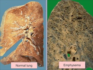 Normal lung Emphysema 