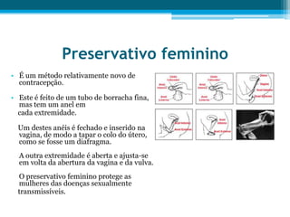 Preservativo femininoÉ um método relativamente novo de contracepção. Este é feito de um tubo de borracha fina, mas tem um anel em     cada extremidade.     Um destes anéis é fechado e inserido na vagina, de modo a tapar o colo do útero, como se fosse um diafragma.A outra extremidade é aberta e ajusta-se em volta da abertura da vagina e da vulva.O preservativo feminino protege as mulheres das doenças sexualmente    transmissíveis.