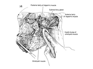 Dissection Neck C:Neck Dissection | PPT