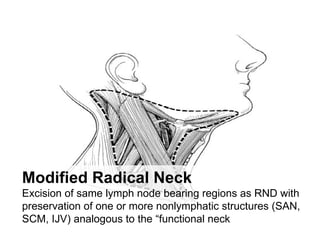 Modified Radical Neck   Excision of same lymph node bearing regions as RND with preservation of one or more nonlymphatic s...