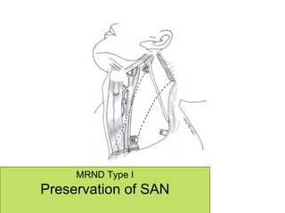 MRND Type I Preservation of SAN 