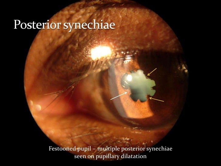Overview of uveitis Part2 Clinical features