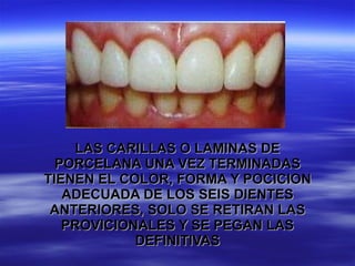 LAS CARILLAS O LAMINAS DE PORCELANA UNA VEZ TERMINADAS TIENEN EL COLOR, FORMA Y POCICION ADECUADA DE LOS SEIS DIENTES ANTERIORES, SOLO SE RETIRAN LAS PROVICIONALES Y SE PEGAN LAS DEFINITIVAS