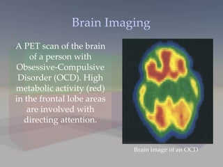A PET scan of the brain of a person with Obsessive-Compulsive Disorder (OCD). High metabolic activity (red) in the frontal lobe areas are involved with directing attention. Brain Imaging Brain image of an OCD 