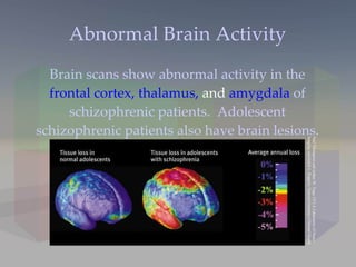 Abnormal Brain Activity Brain scans show abnormal activity in the  frontal cortex, thalamus,  and  amygdala  of schizophrenic patients.  Adolescent schizophrenic patients also have brain lesions. Paul Thompson and Arthur W. Toga, UCLA Laboratory of Neuro  Imaging and Judith L. Rapport, National Institute of Mental Health 
