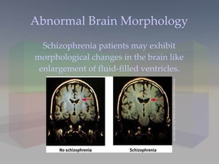 Abnormal Brain Morphology Schizophrenia patients may exhibit morphological changes in the brain like enlargement of fluid-filled ventricles. Both Photos: Courtesy of Daniel R. Weinberger, M.D., NIH-NIMH/ NSC 