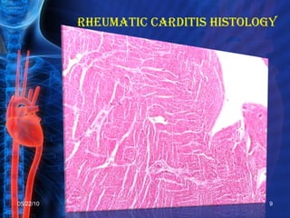 Rheumatic Fever by Adnan Bhutto | PPT