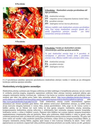 9 Paveikslas
9 Paveikslas: Vaizdas po slankstelinės arterijos
rekonstrukcijos aukščiau aprašyta metodika.
Ta pati slankste...