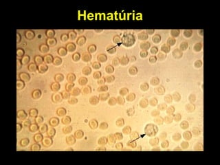 Hematúria 