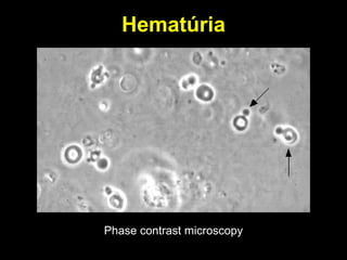 Hematúria Phase contrast microscopy 