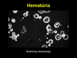 Hematúria Scanning microscopy 