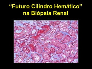 “ Futuro Cilindro Hemático” na Biópsia Renal 