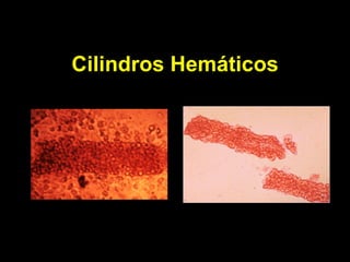 Cilindros Hemáticos 