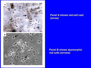 Panel A shows red-cell cast (arrow) Panel B shows dysmorphic red cells (arrows) 