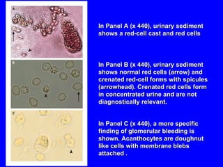 In Panel A (x 440), urinary sediment shows a red-cell cast and red cells In Panel B (x 440), urinary sediment shows normal red cells (arrow) and crenated red-cell forms with spicules (arrowhead). Crenated red cells form in concentrated urine and are not diagnostically relevant. In Panel C (x 440), a more specific finding of glomerular bleeding is shown. Acanthocytes are doughnut like cells with membrane blebs attached . 